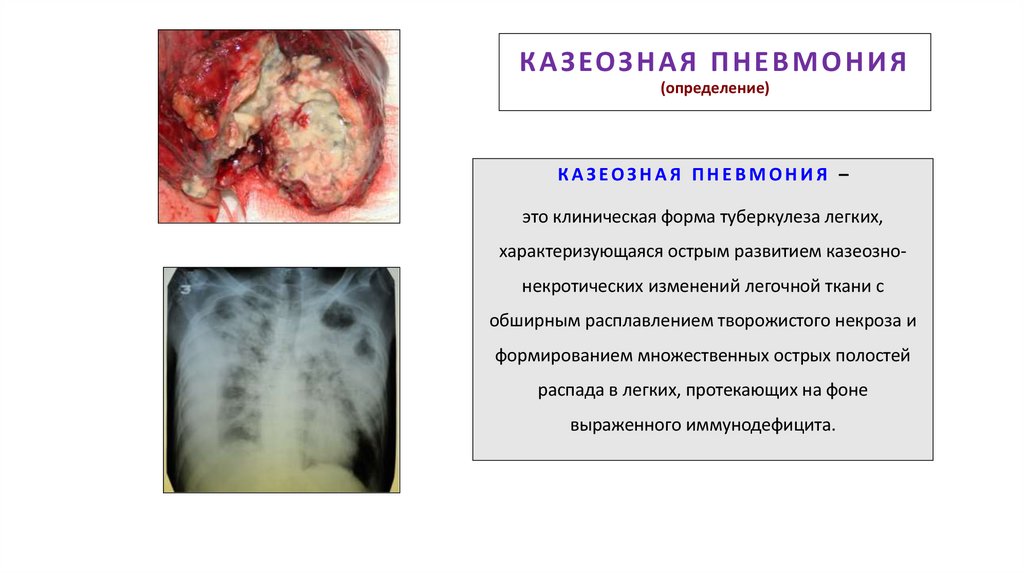 КАЗЕОЗНАЯ ПНЕВМОНИЯ (определение)