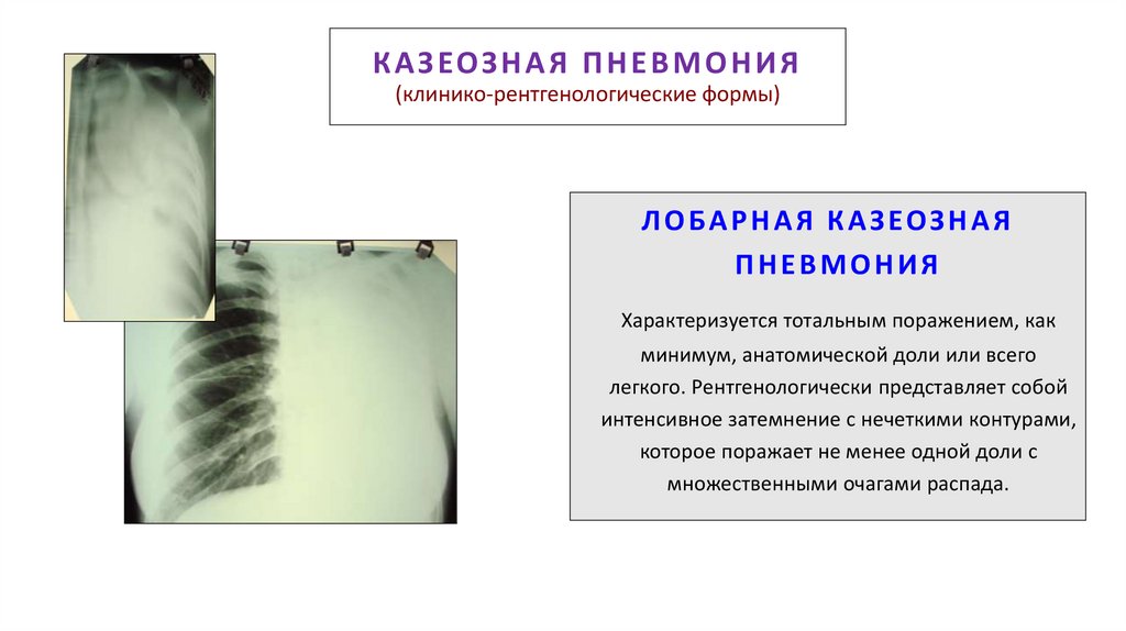 КАЗЕОЗНАЯ ПНЕВМОНИЯ (клинико-рентгенологические формы)