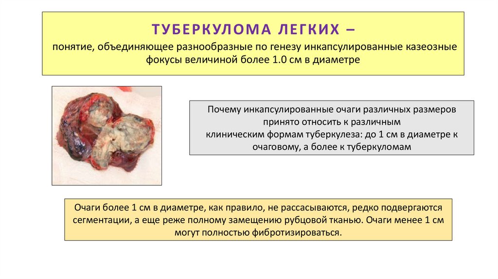 ТУБЕРКУЛОМА ЛЕГКИХ – понятие, объединяющее разнообразные по генезу инкапсулированные казеозные фокусы величиной более 1.0 см в