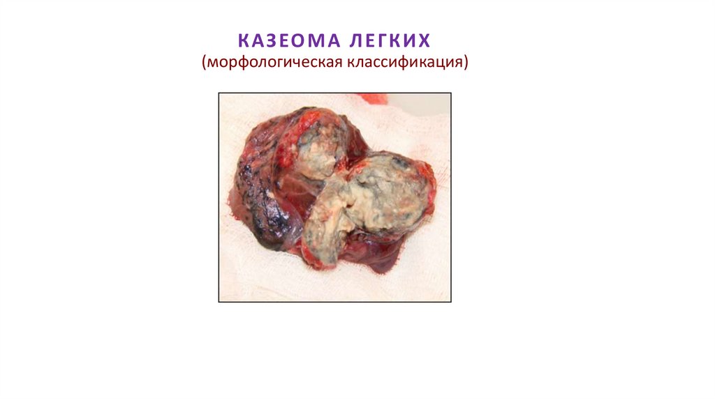 КАЗЕОМА ЛЕГКИХ (морфологическая классификация)