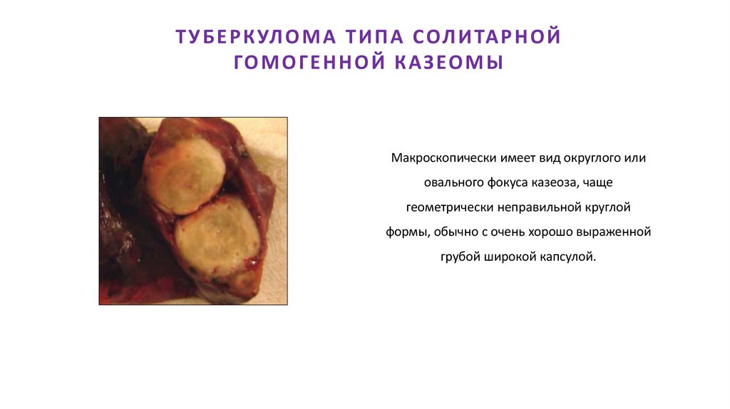 ТУБЕРКУЛОМА ТИПА СОЛИТАРНОЙ ГОМОГЕННОЙ КАЗЕОМЫ