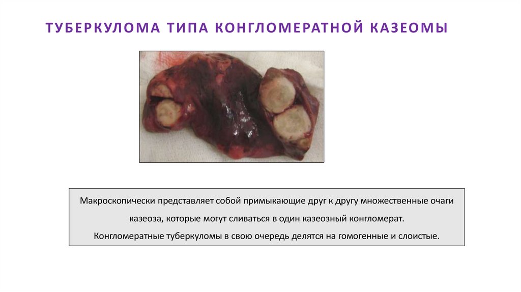 ТУБЕРКУЛОМА ТИПА КОНГЛОМЕРАТНОЙ КАЗЕОМЫ