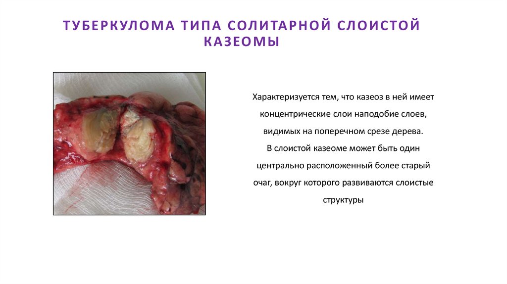 ТУБЕРКУЛОМА ТИПА СОЛИТАРНОЙ СЛОИСТОЙ КАЗЕОМЫ