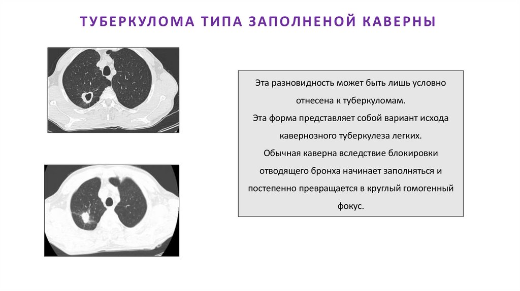 ТУБЕРКУЛОМА ТИПА ЗАПОЛНЕНОЙ КАВЕРНЫ