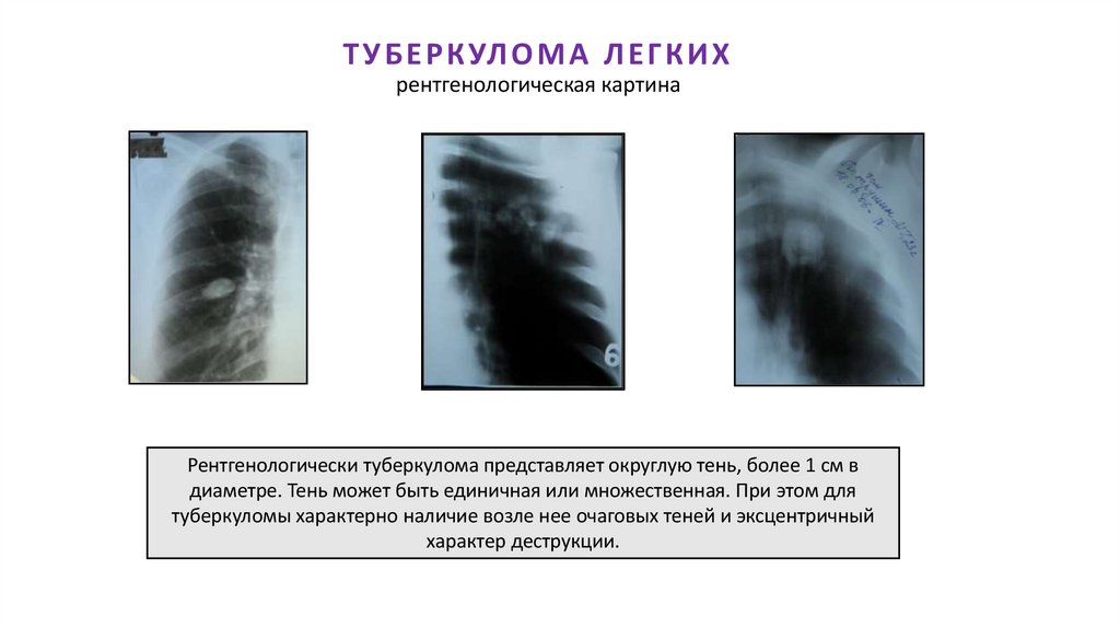 ТУБЕРКУЛОМА ЛЕГКИХ рентгенологическая картина