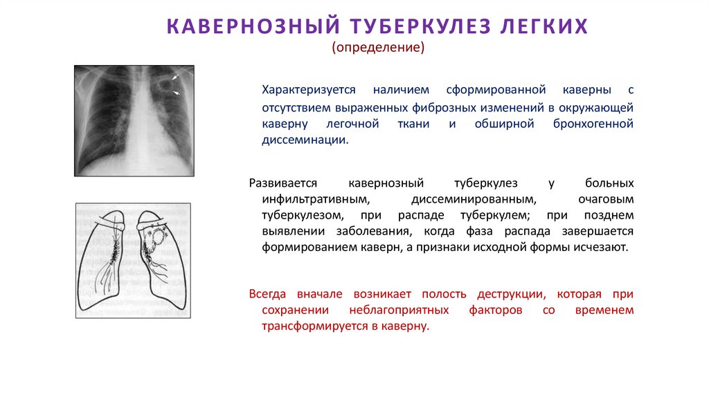 КАВЕРНОЗНЫЙ ТУБЕРКУЛЕЗ ЛЕГКИХ (определение)