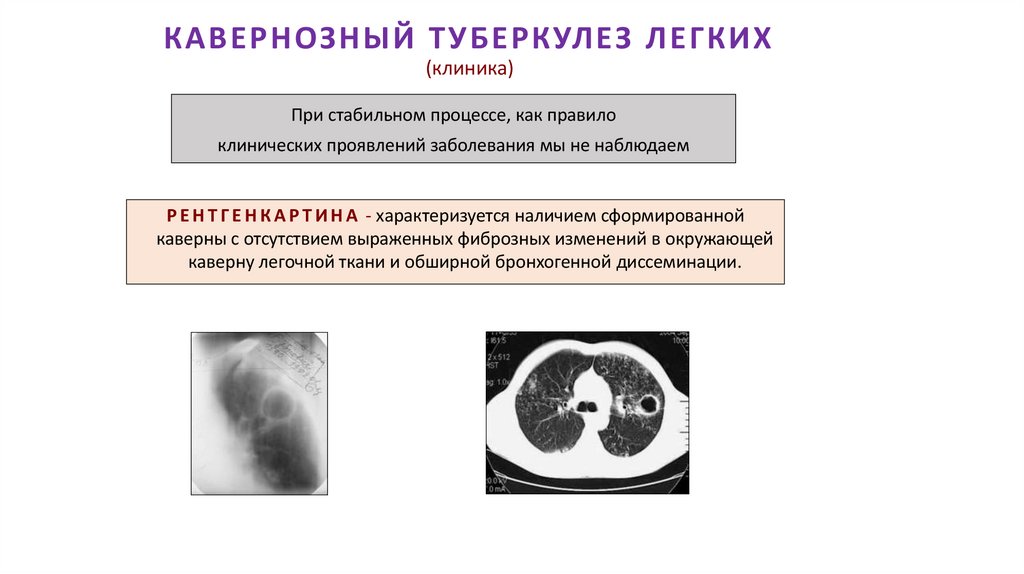 КАВЕРНОЗНЫЙ ТУБЕРКУЛЕЗ ЛЕГКИХ (клиника)