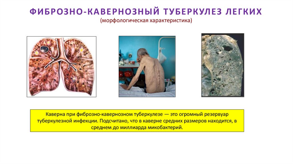 ФИБРОЗНО-КАВЕРНОЗНЫЙ ТУБЕРКУЛЕЗ ЛЕГКИХ (морфологическая характеристика)
