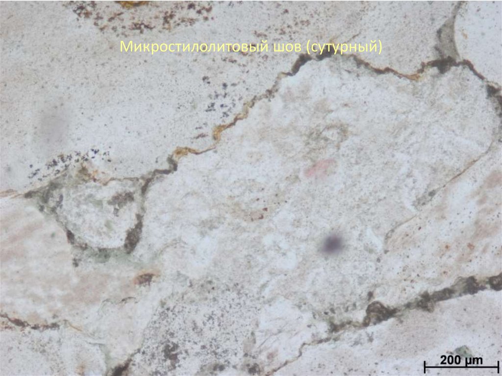 Микростилолитовый шов (сутурный)