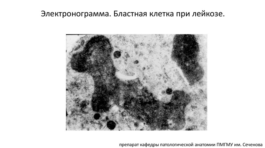 Электронограмма. Бластная клетка при лейкозе.