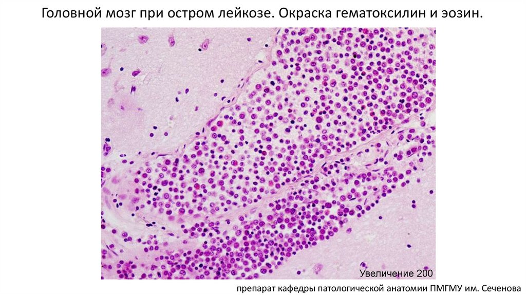 Головной мозг при остром лейкозе. Окраска гематоксилин и эозин.