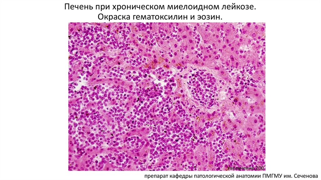 Печень при хроническом миелоидном лейкозе. Окраска гематоксилин и эозин.