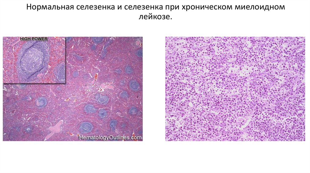 Нормальная селезенка и селезенка при хроническом миелоидном лейкозе.