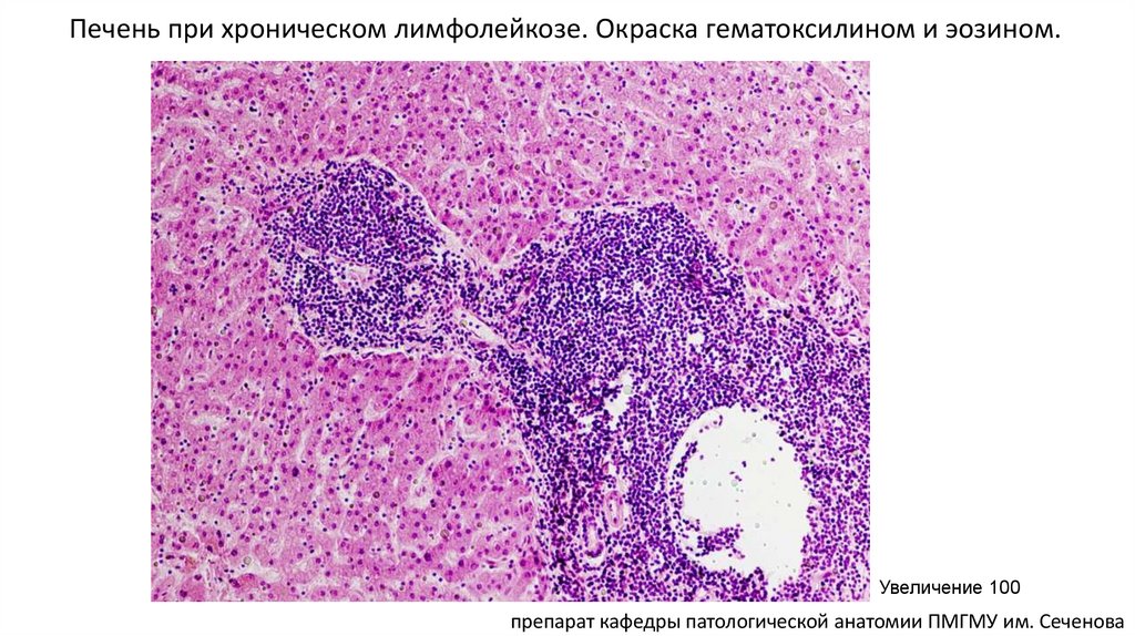 Печень при хроническом лимфолейкозе. Окраска гематоксилином и эозином.