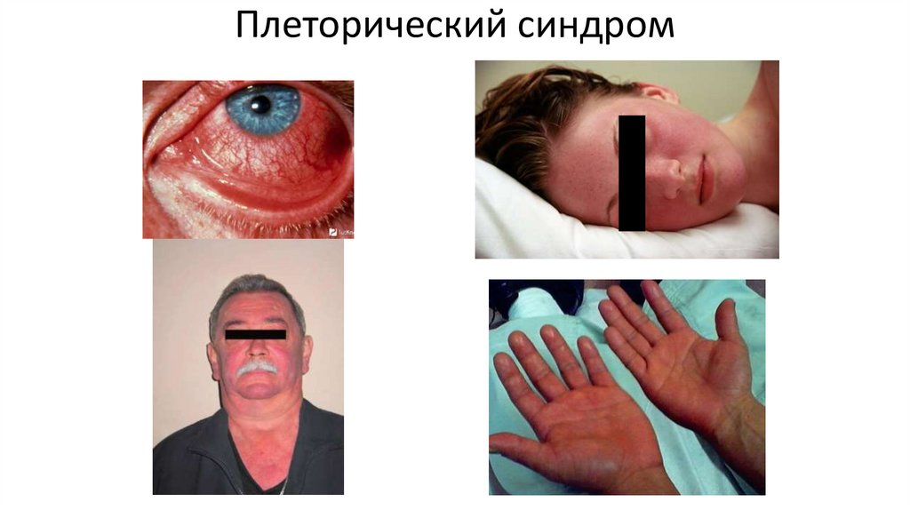 Плеторический синдром