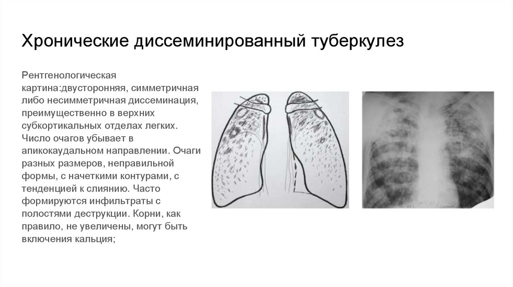 Хронические диссеминированный туберкулез