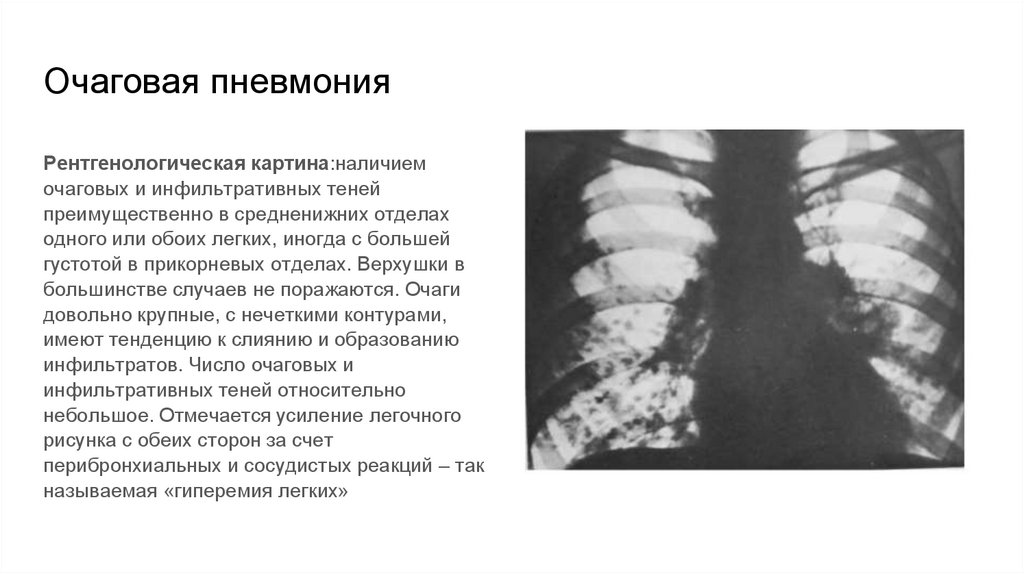 Очаговая пневмония