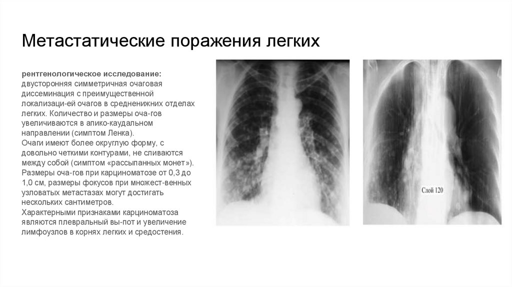 Метастатические поражения легких