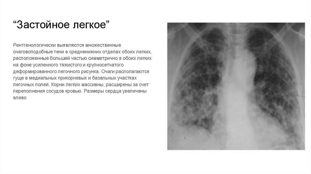 “Застойное легкое”