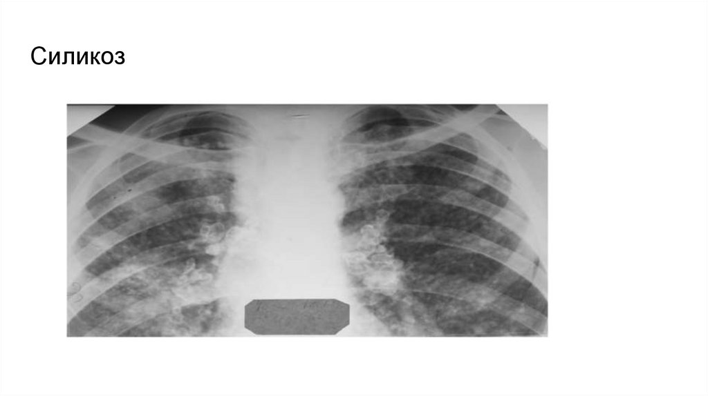 Силикоз