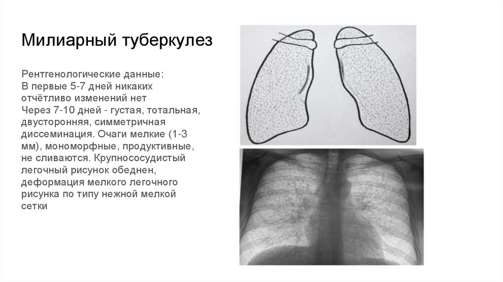 Милиарный туберкулез
