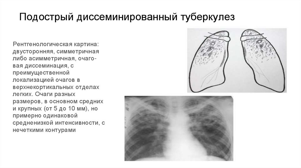 Подострый диссеминированный туберкулез
