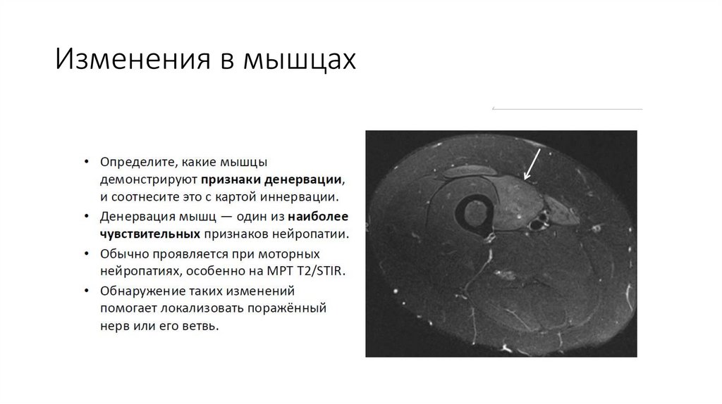Изменения в мышцах