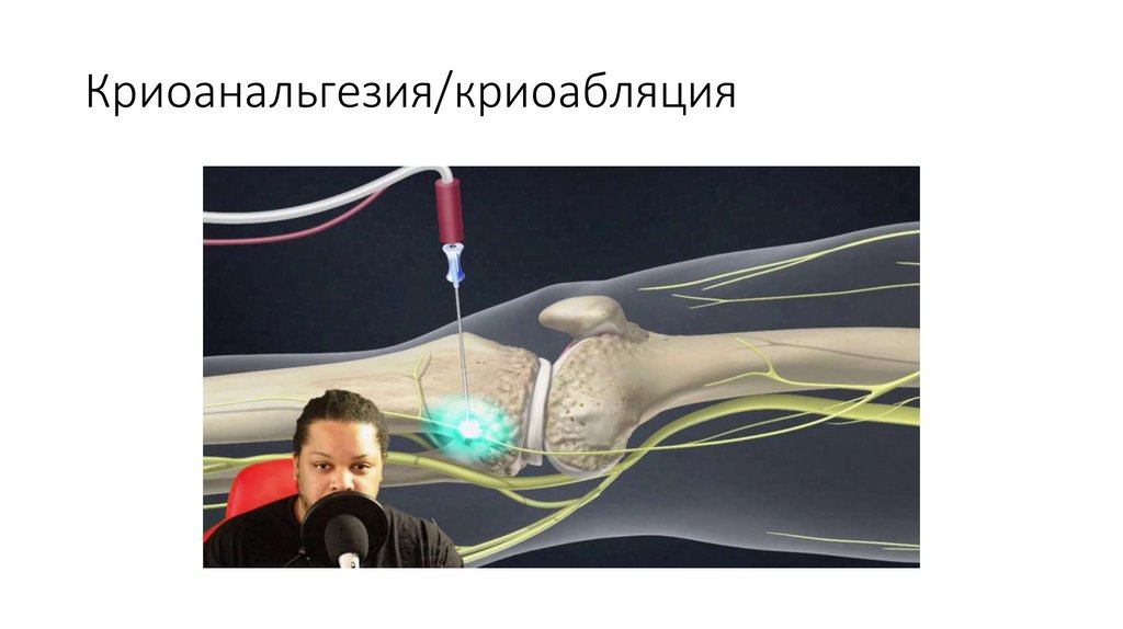 Криоанальгезия/криоабляция