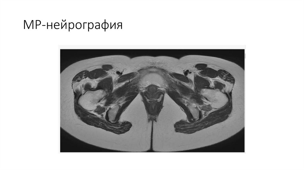 МР-нейрография