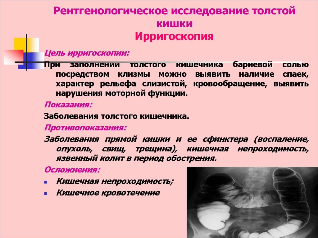 Рентгенологическое исследование толстой кишки Ирригоскопия