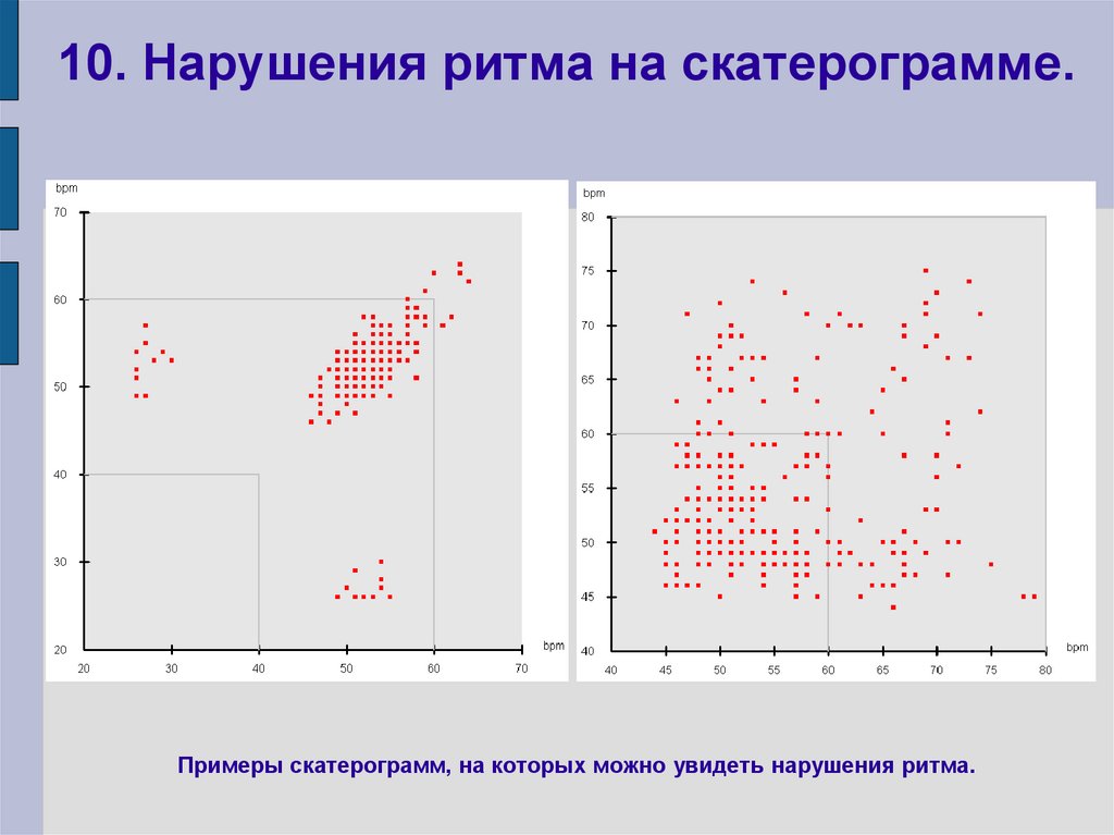 10. Нарушения ритма на скатерограмме.