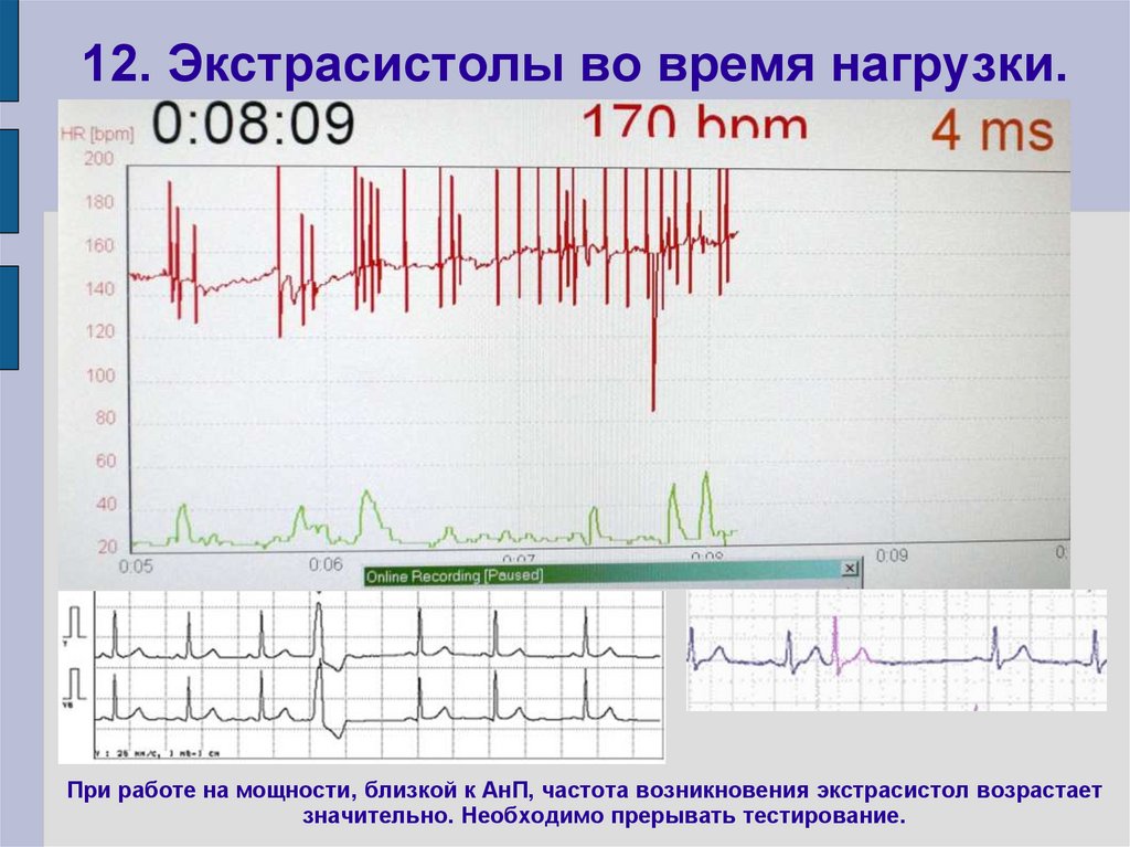 12. Экстрасистолы во время нагрузки.