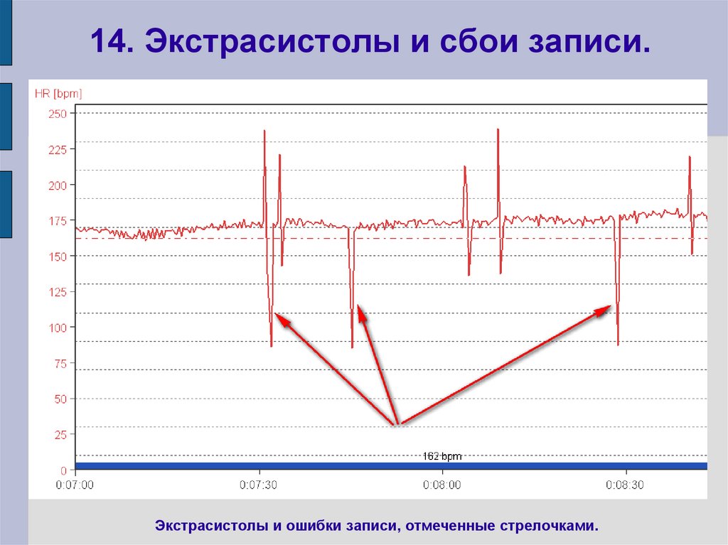 14. Экстрасистолы и сбои записи.