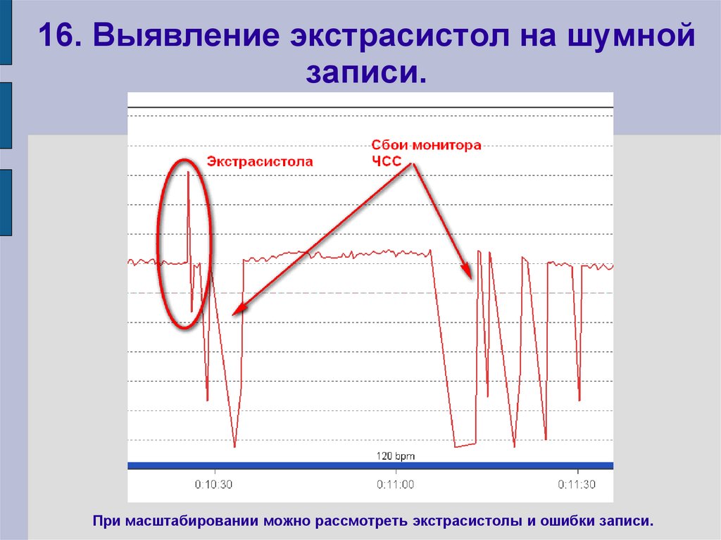 16. Выявление экстрасистол на шумной записи.