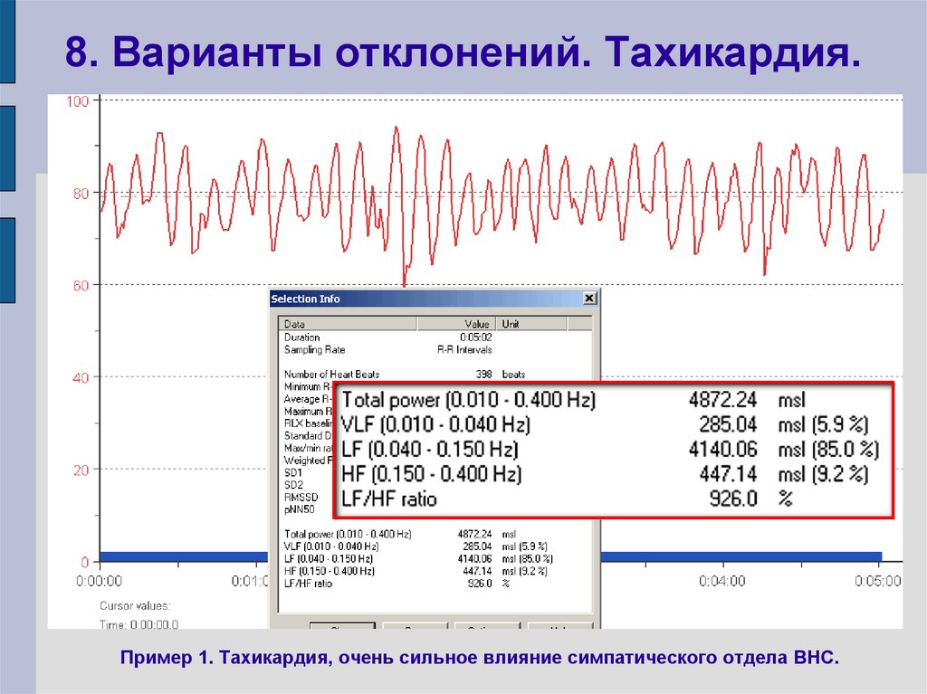 8. Варианты отклонений. Тахикардия.