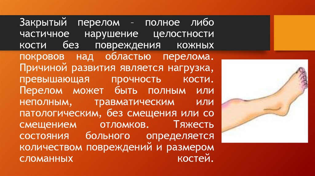 Закрытый перелом – полное либо частичное нарушение целостности кости без повреждения кожных покровов над областью перелома.