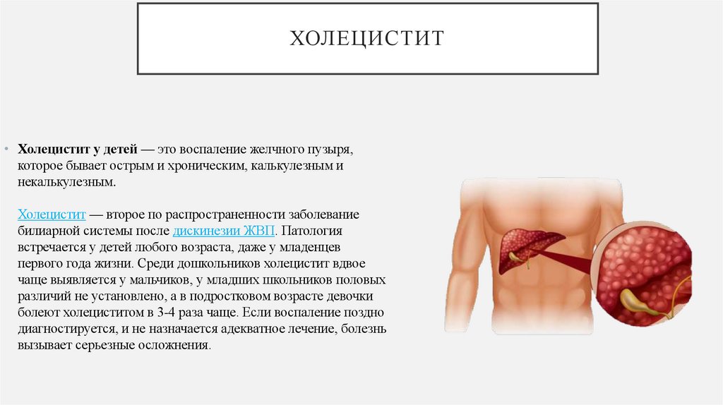 Холецистит