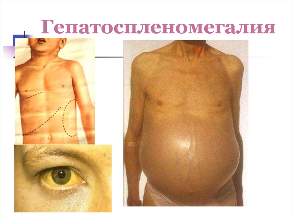 Гепатоспленомегалия