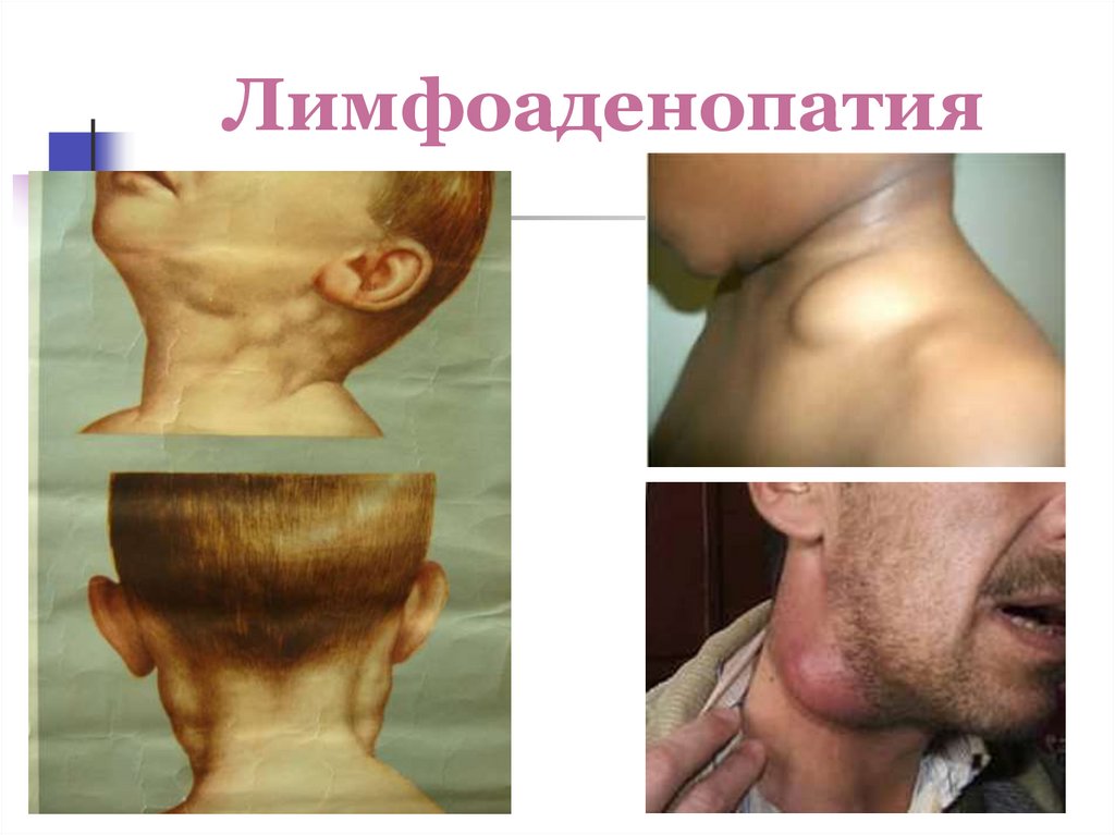 Лимфоаденопатия