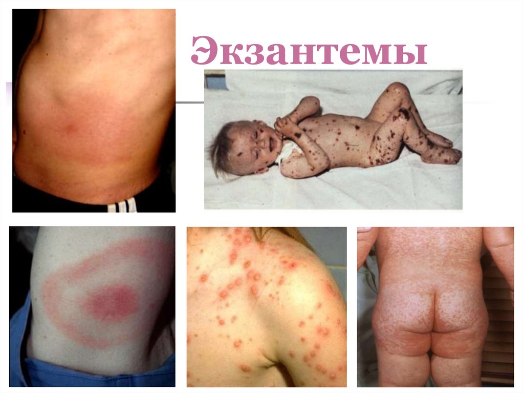 Экзантемы