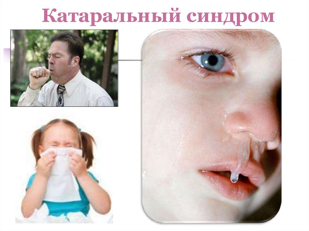 Катаральный синдром