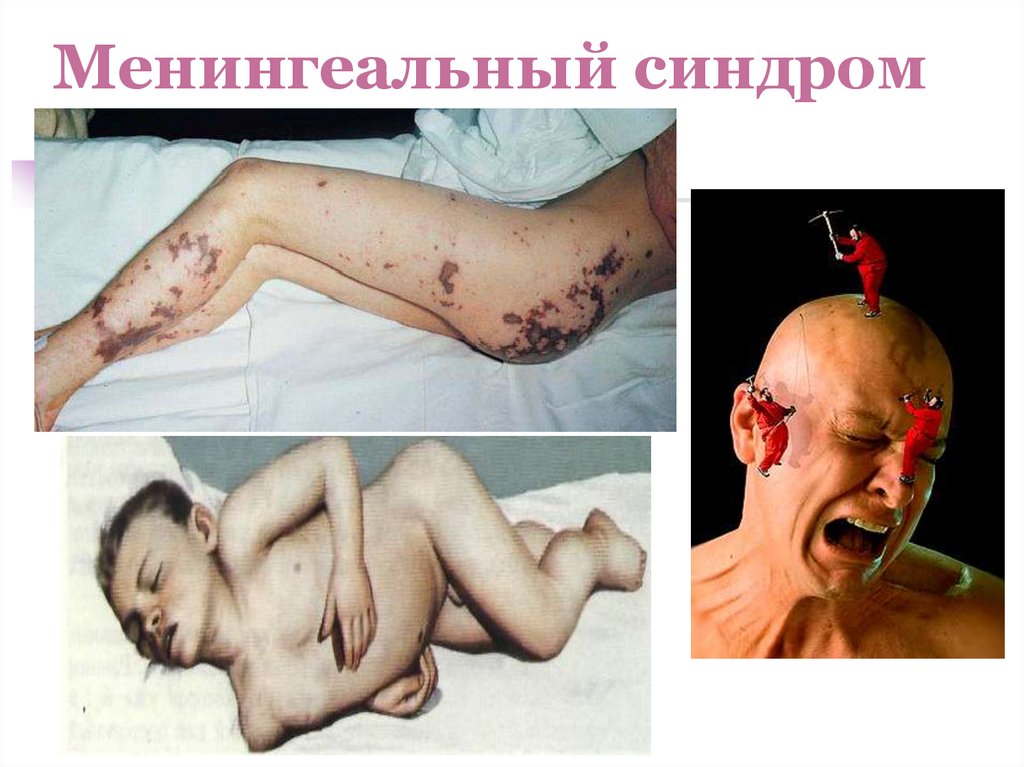 Менингеальный синдром