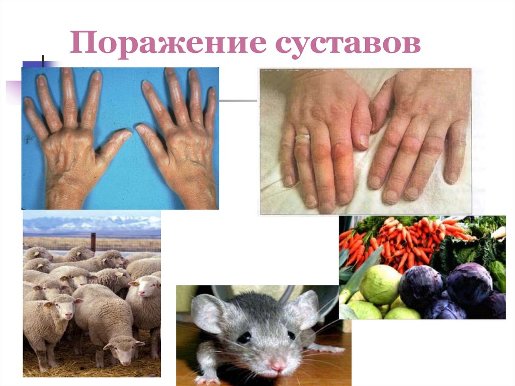 Поражение суставов