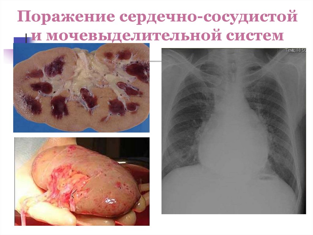Поражение сердечно-сосудистой и мочевыделительной систем