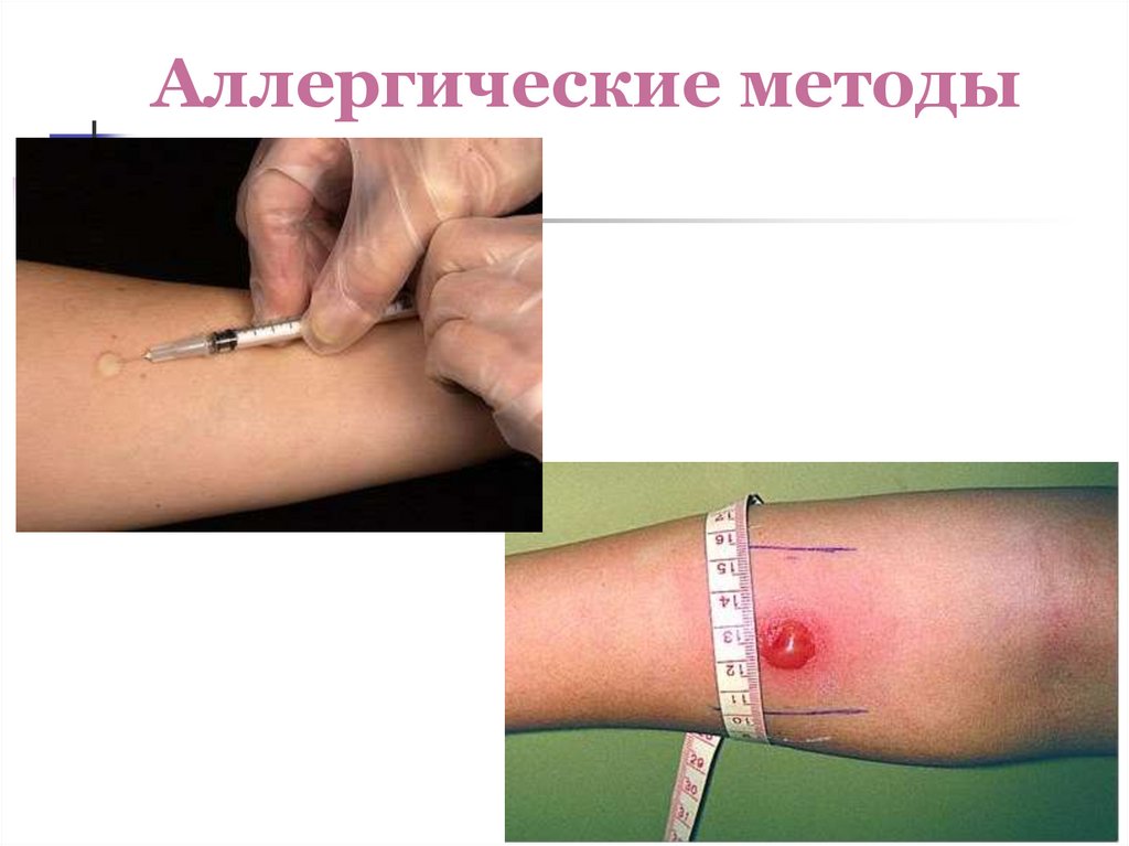 Аллергические методы