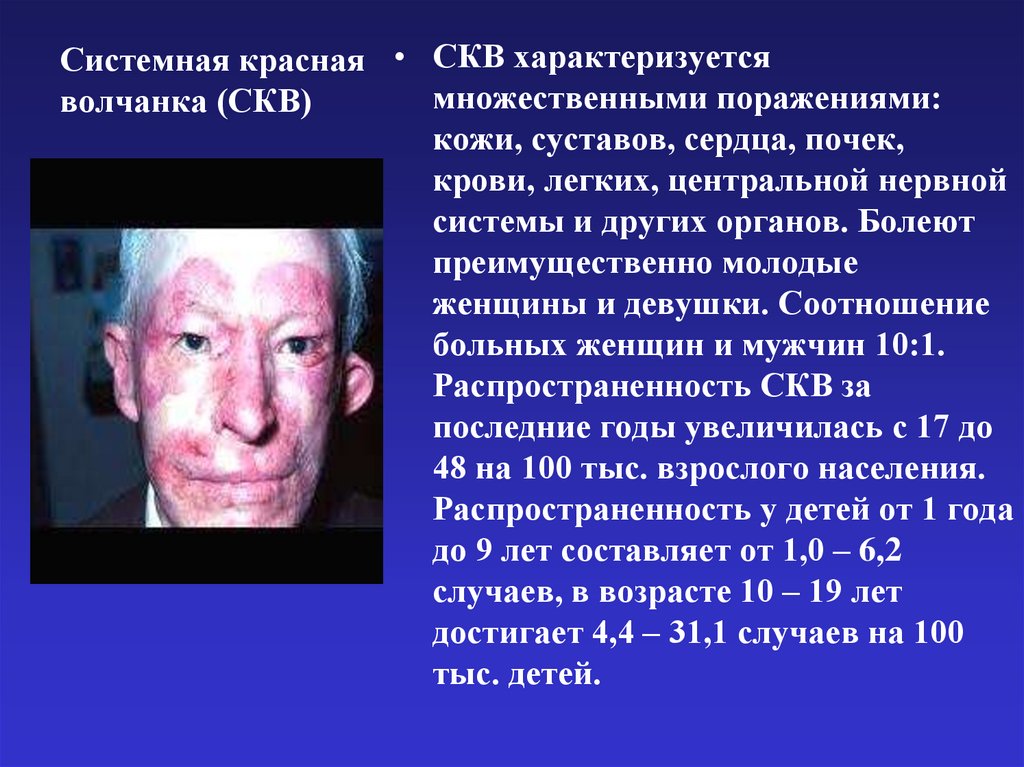 Системная красная волчанка (СКВ)