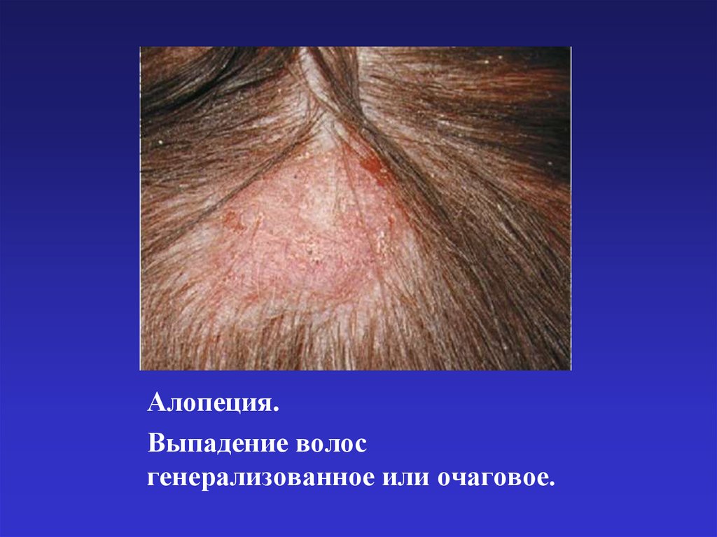Алопеция.