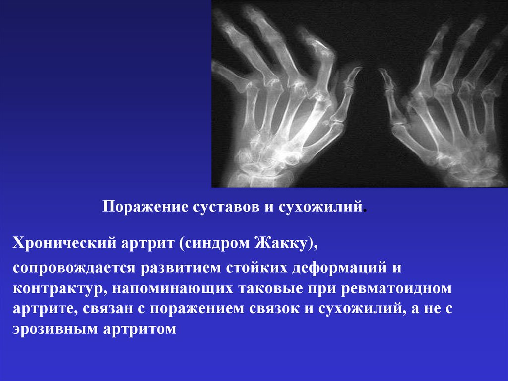 Поражение суставов и сухожилий.