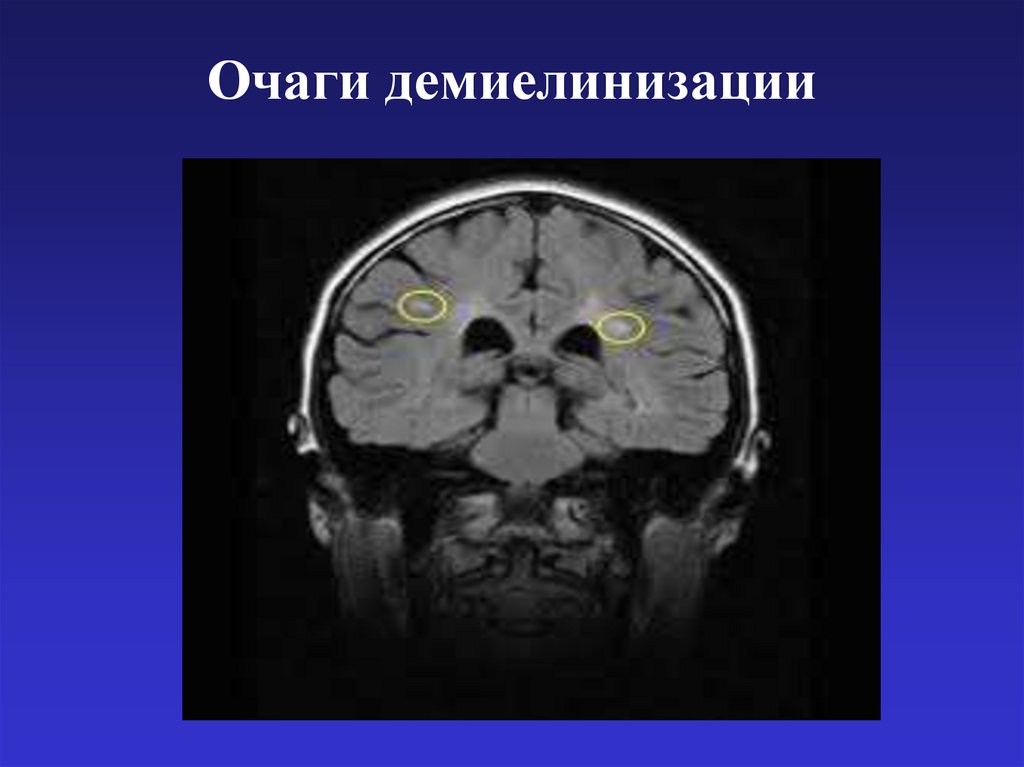 Очаги демиелинизации