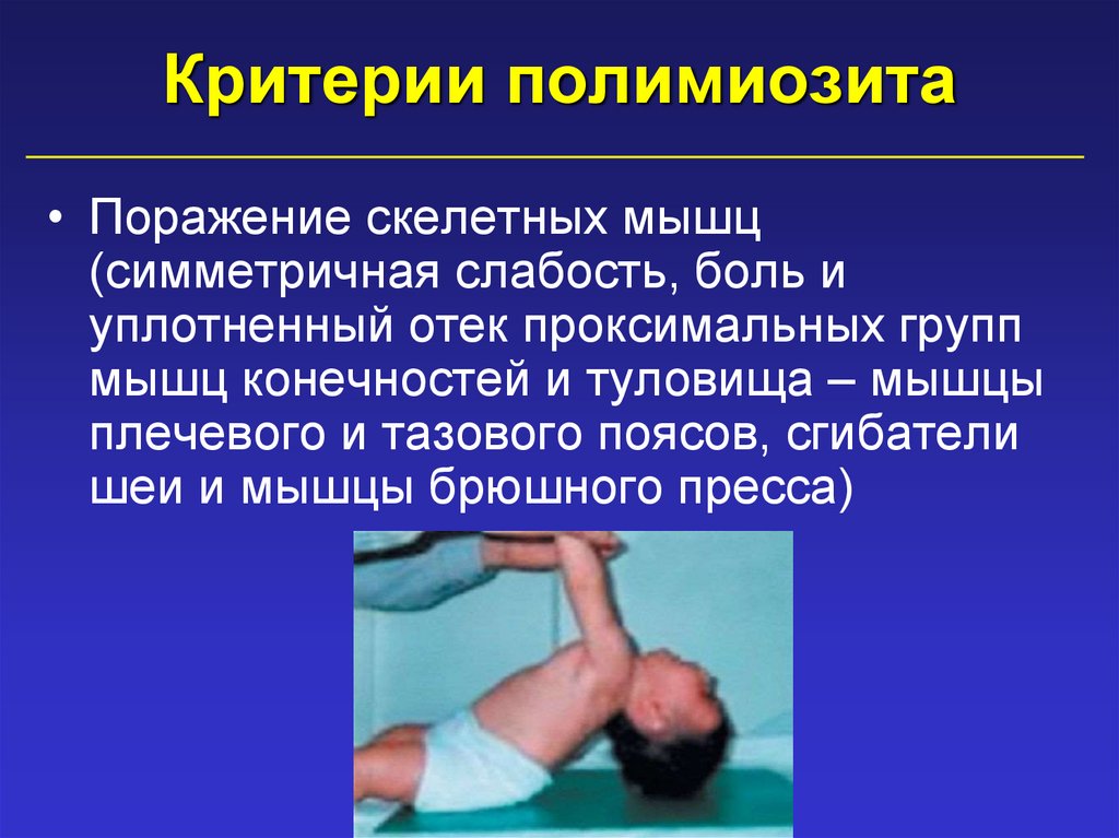 Критерии полимиозита